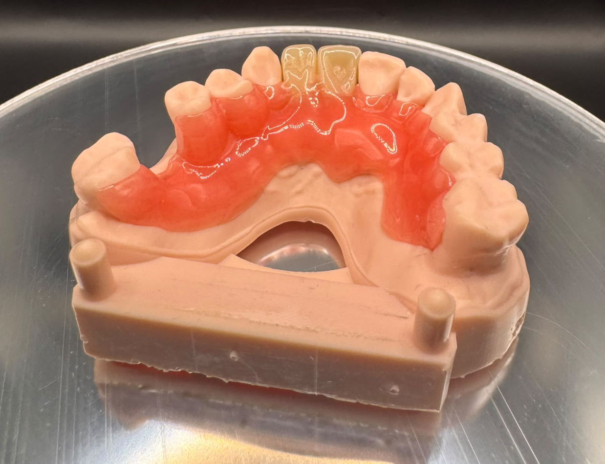 Pink partial denture with anterior replacement teeth seated on an upper dental model